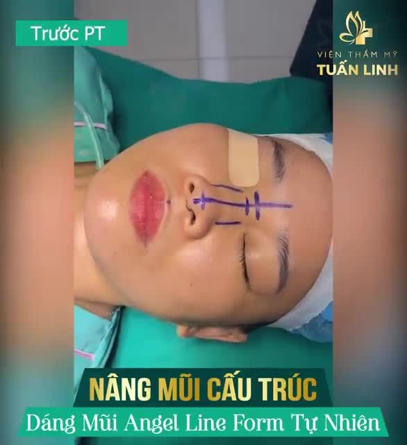 Tạm biệt dáng mũi thấp kém thon gọn