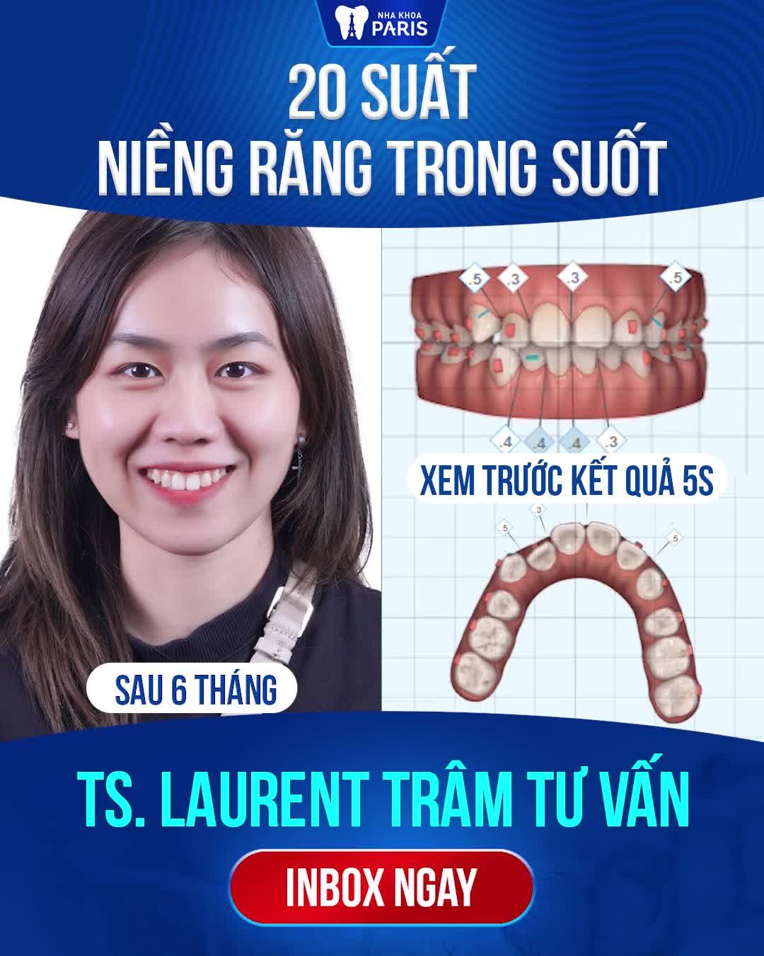 Niềng răng trong suốt Invisalign - Tết đeo niềng vẫn đẹp!