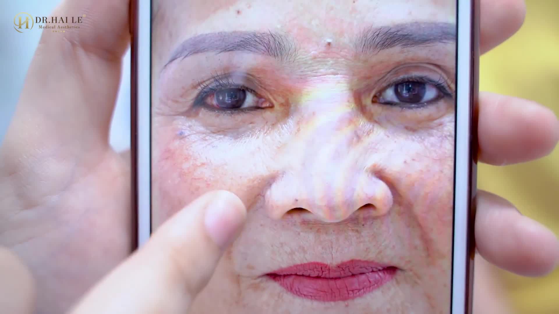 Nâng cung mày tại Dr.Hải Lê cơ sở HCM