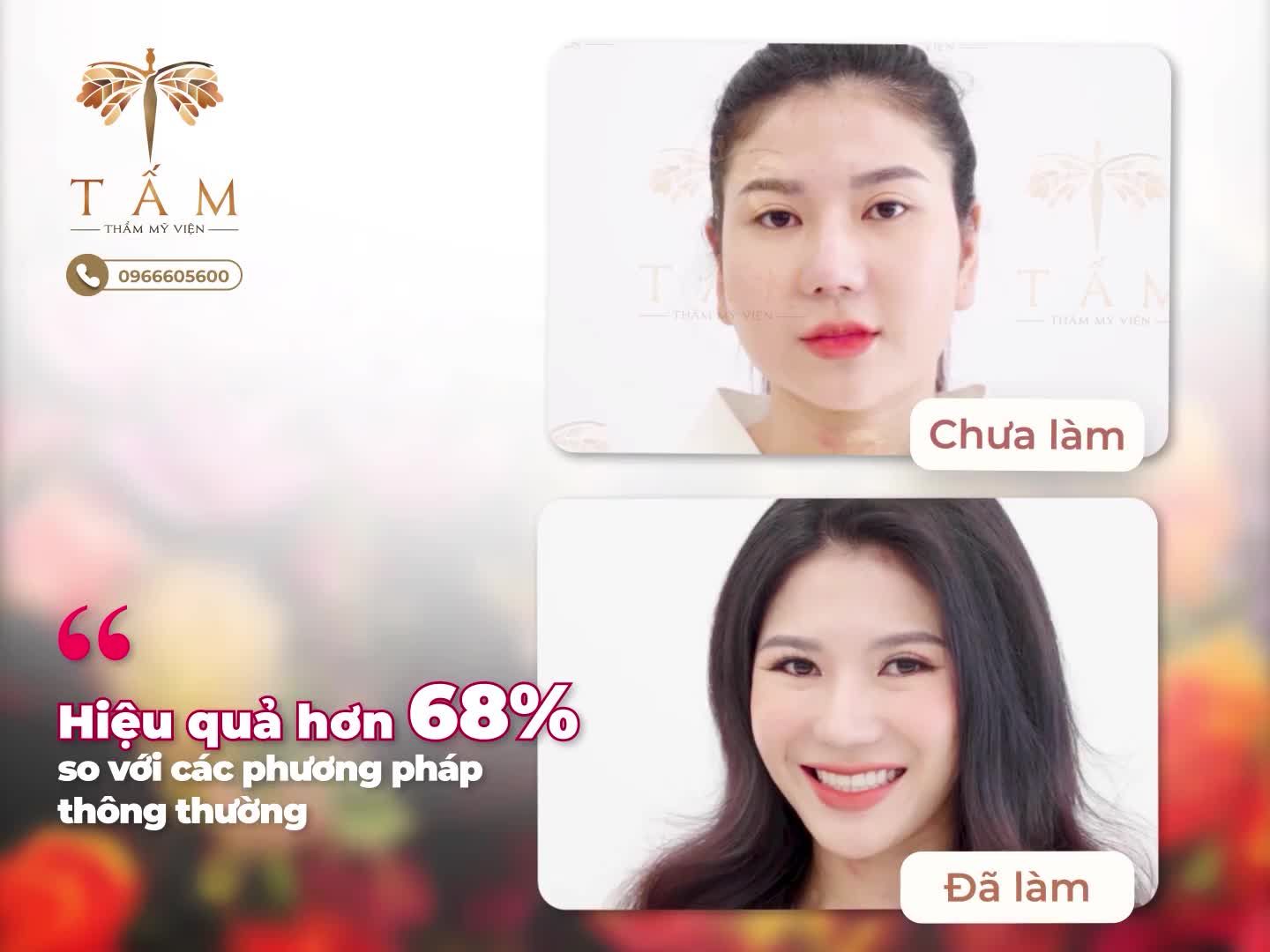 1 LẦN DUY NHẤT - MẶT VLINE TỨC THÌ