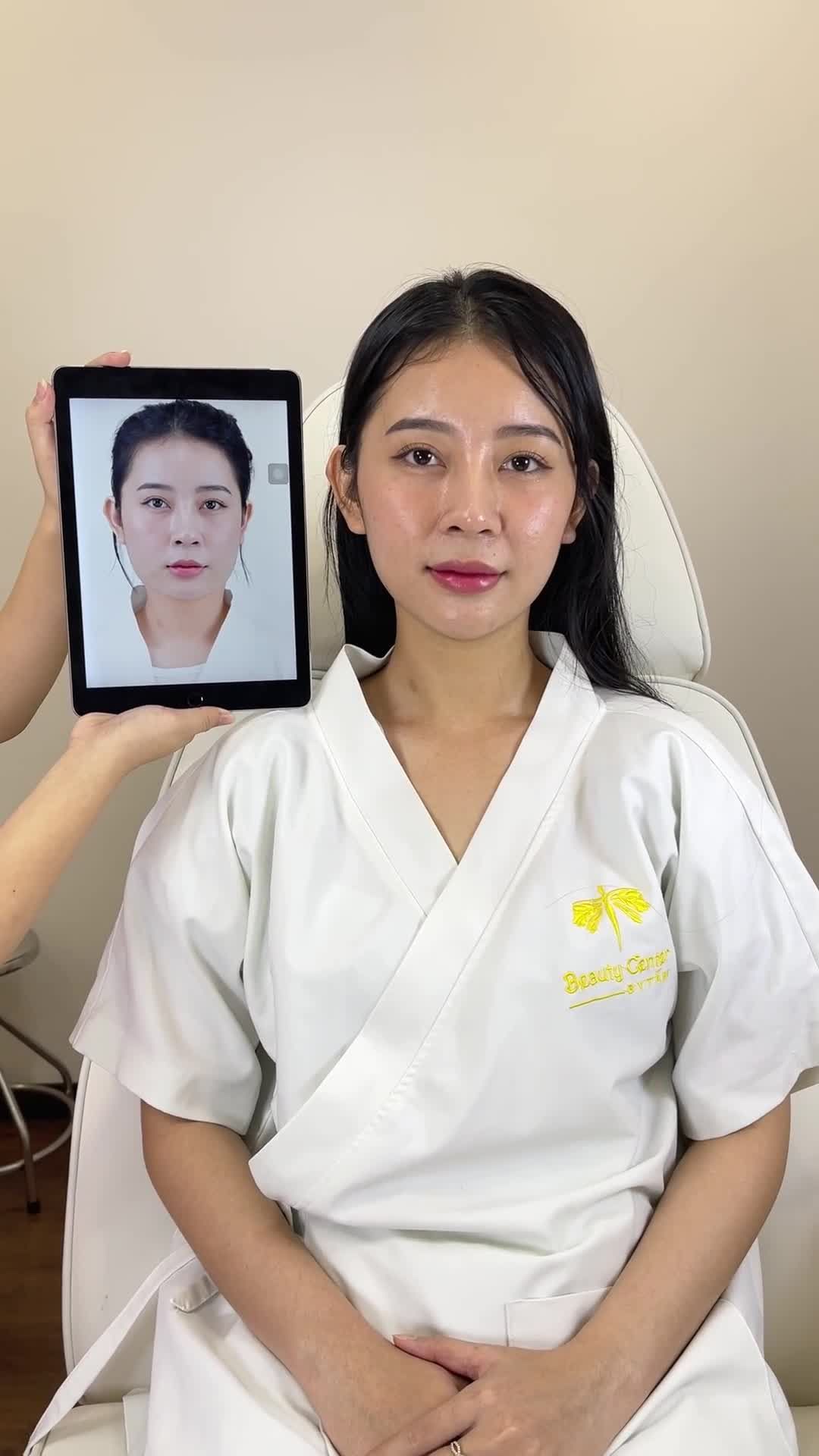 Ca Vline Perfect của khách hàng sau 1 tháng quay lại tái khám tại Tấm.