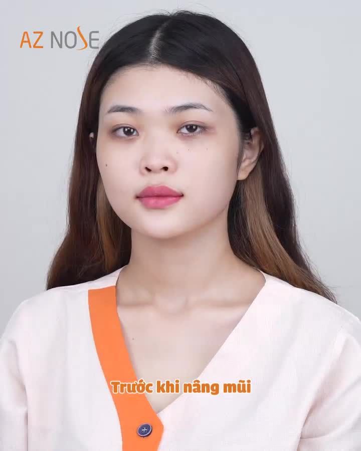 Dáng mũi 1 tháng tuổi thực hiện bởi Bác sĩ Hoàng Nhung đây ạ!