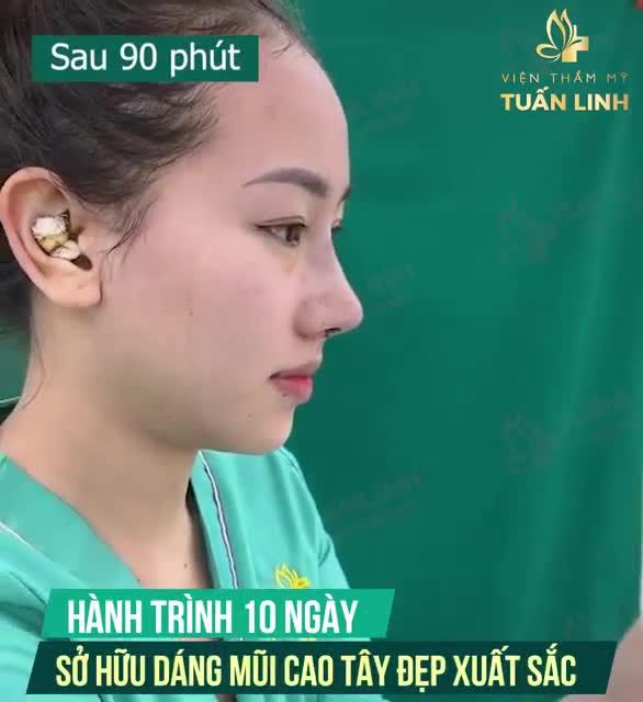 CHỈ SAU 10 NGÀY BẠN CÓ THỂ SỞ HỮU CHIẾC MŨI CAO SIÊU ĐẸP