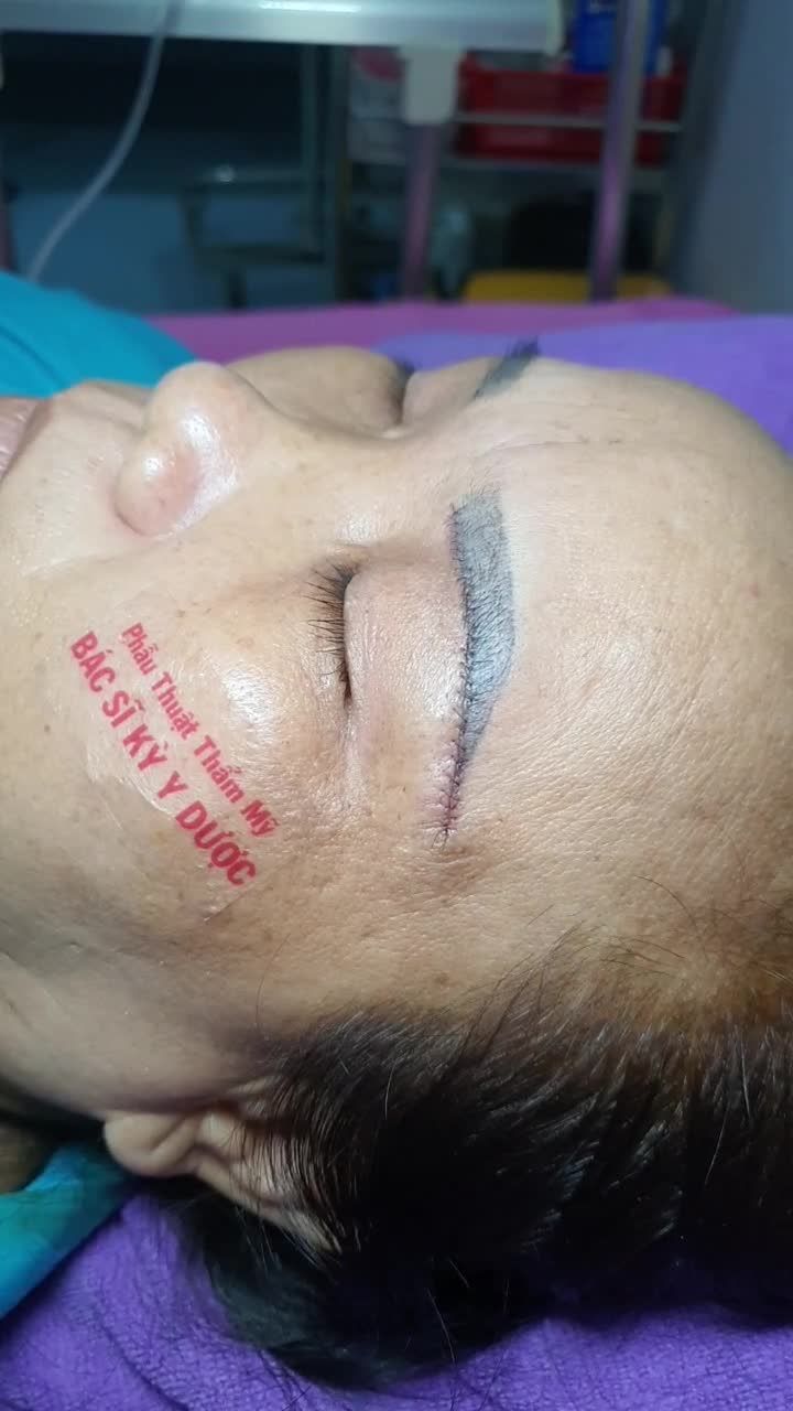Treo chân mày Cân cơ cho Chị khách dễ thương