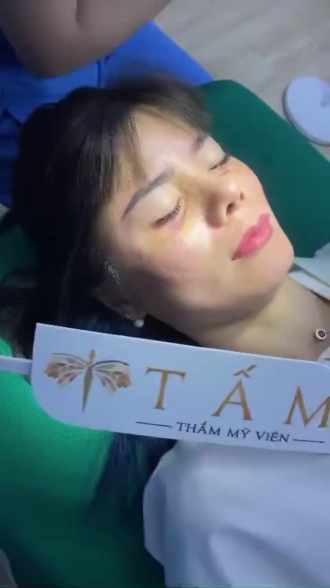 Khách hàng qua phòng khám tháo nẹp cắt chỉ. Cơ địa tuy hơi bầm nhưng dáng mũi đã gom dần