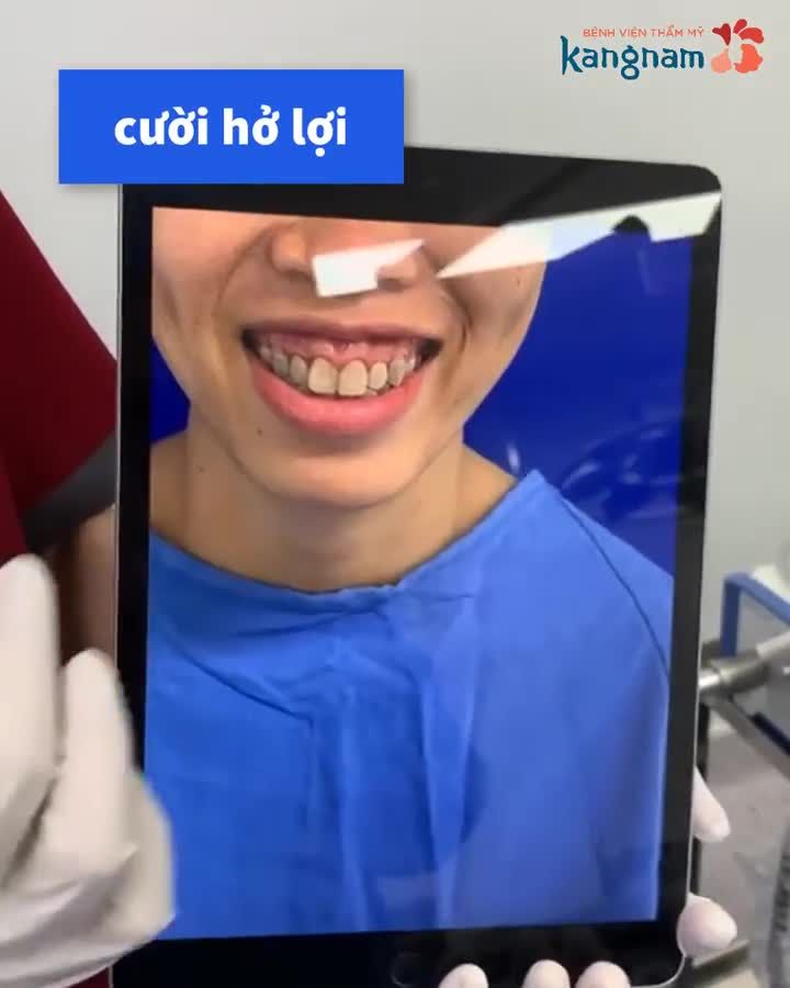 Bác sĩ Annie show ngay kết quả sau 120 phút cho case khách hàng chỉnh hàm mặt