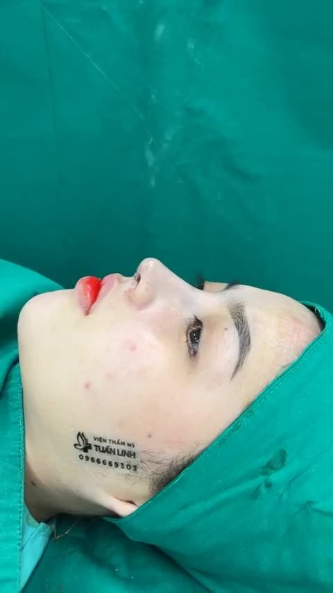 Case mũi Siêu cấu trúc surgiform vừa hoàn thành