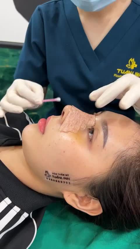 Case mũi cấu trúc sụn mỹ 5 ngày