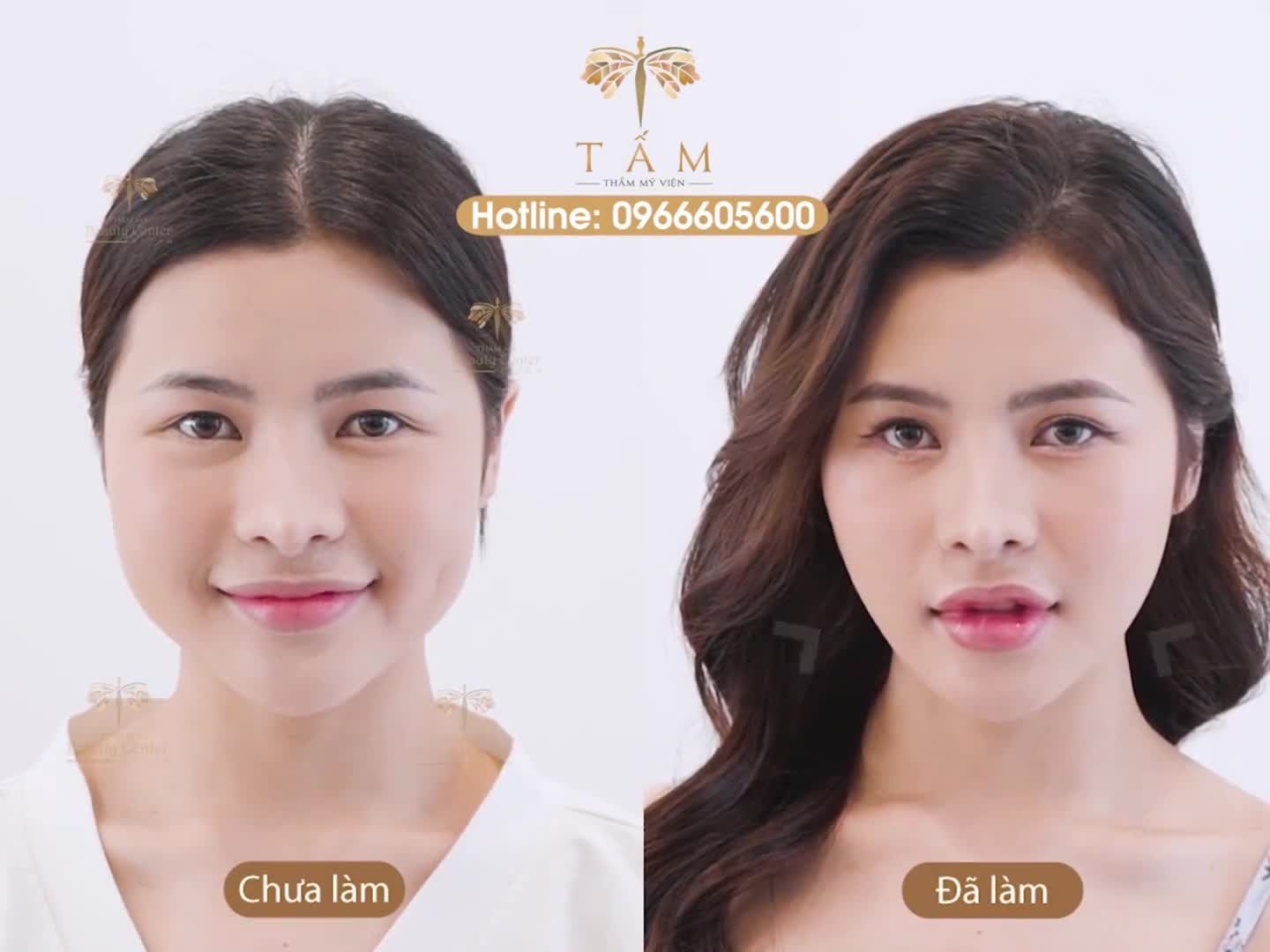 Tạm biệt mặt to góc cạnh với Botox thon gọn hàm