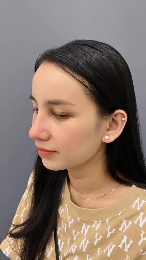 NÂNG MŨI CẤU TRÚC 20 NGÀY GIẢI PHÁP ƯU VIỆT CHO MỌI KHUYẾT ĐIỂM MŨI