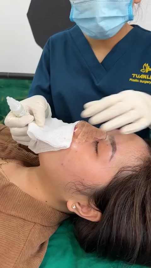 Mũi Siêu cấu trúc được 2 ngày