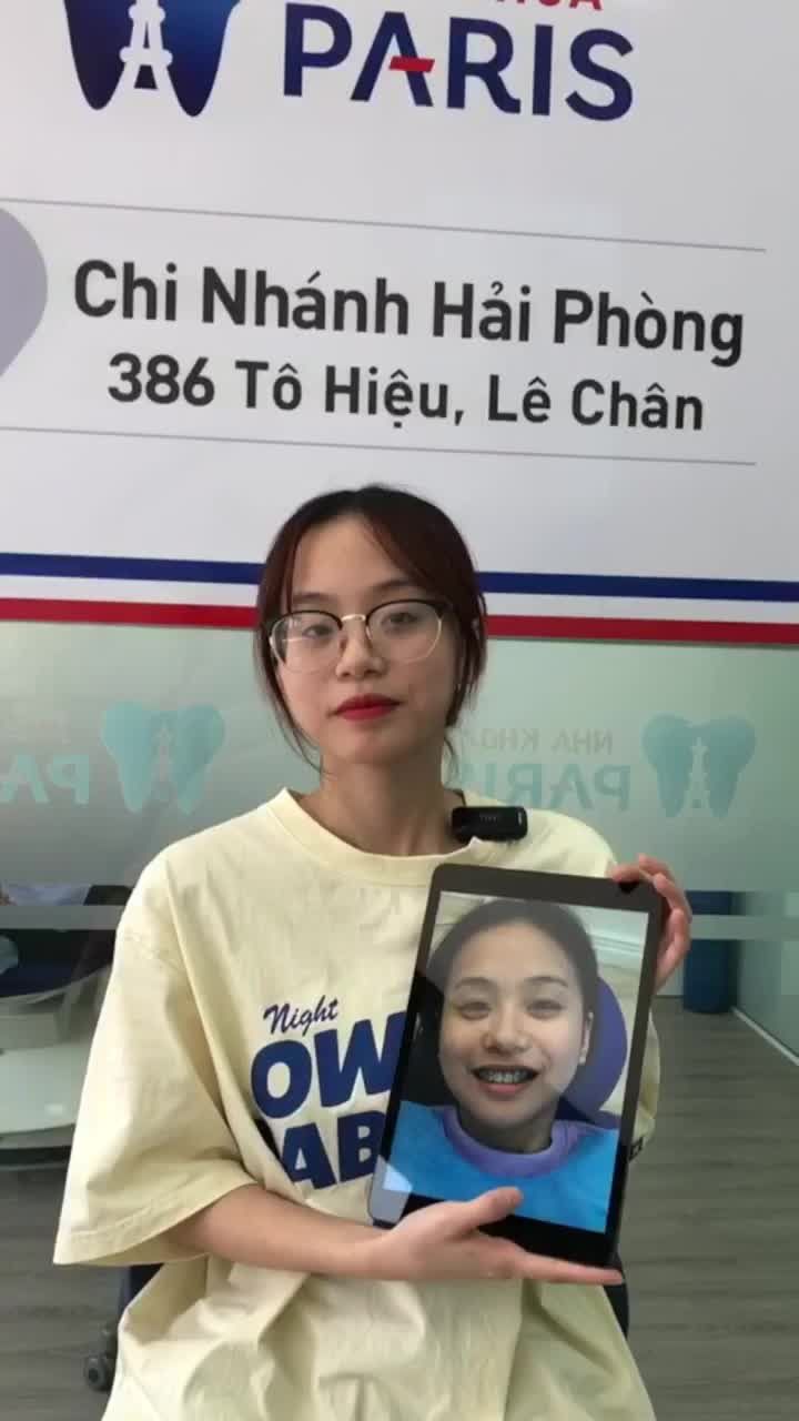 Bạn Võ Hà Minh Anh - sinh viên trường Đại học Thương Mại sau quá trình niềng răng tại Nha khoa Paris - Hải Phòng