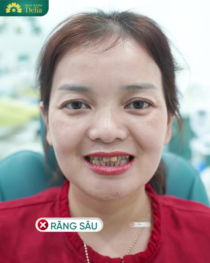 Cảm ơn đội ngũ Delia đã giúp chị có hàm răng trắng sáng, đều đẹp.