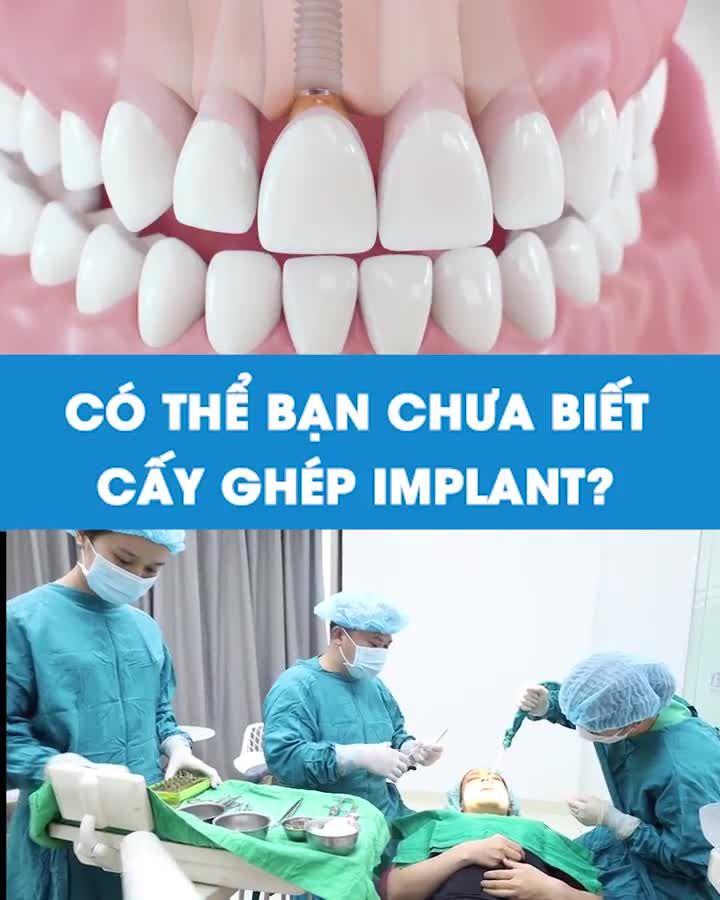 Có thể bạn chưa biết về cấy ghép Implant