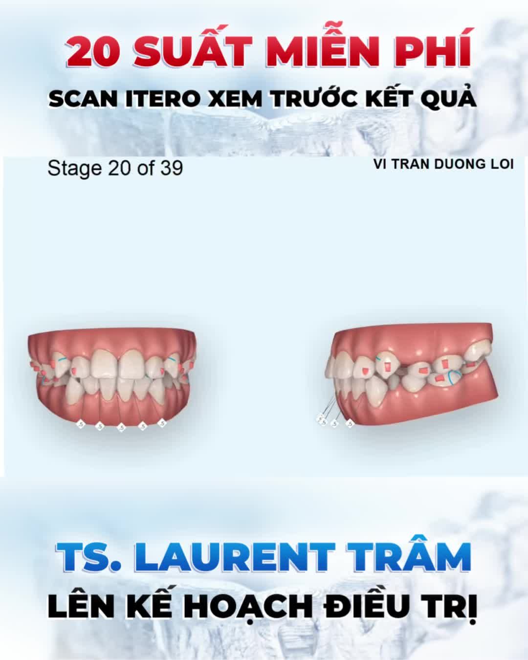 Công nghệ quét dấu răng iTero Element 5D