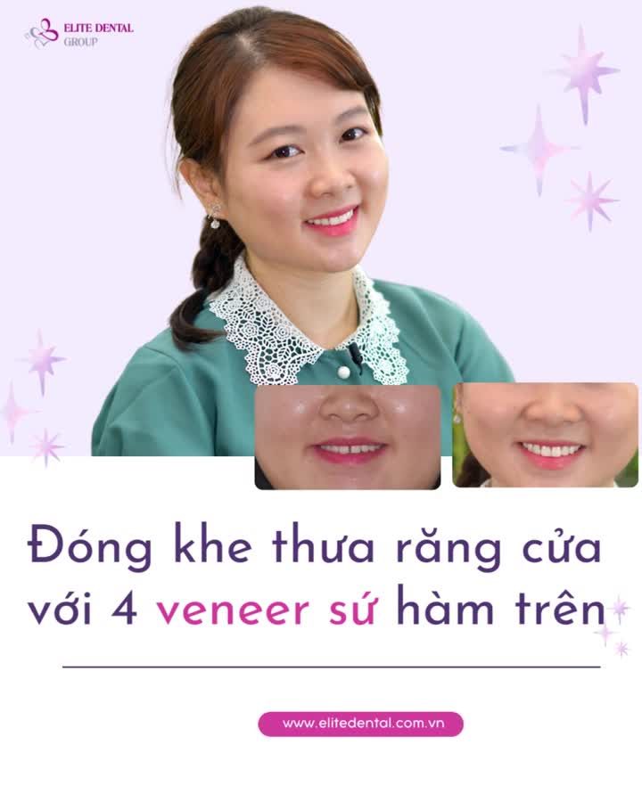 Cười rạng rỡ, tự tin sau khi đóng khe thưa răng cửa với điều trị veneer sứ