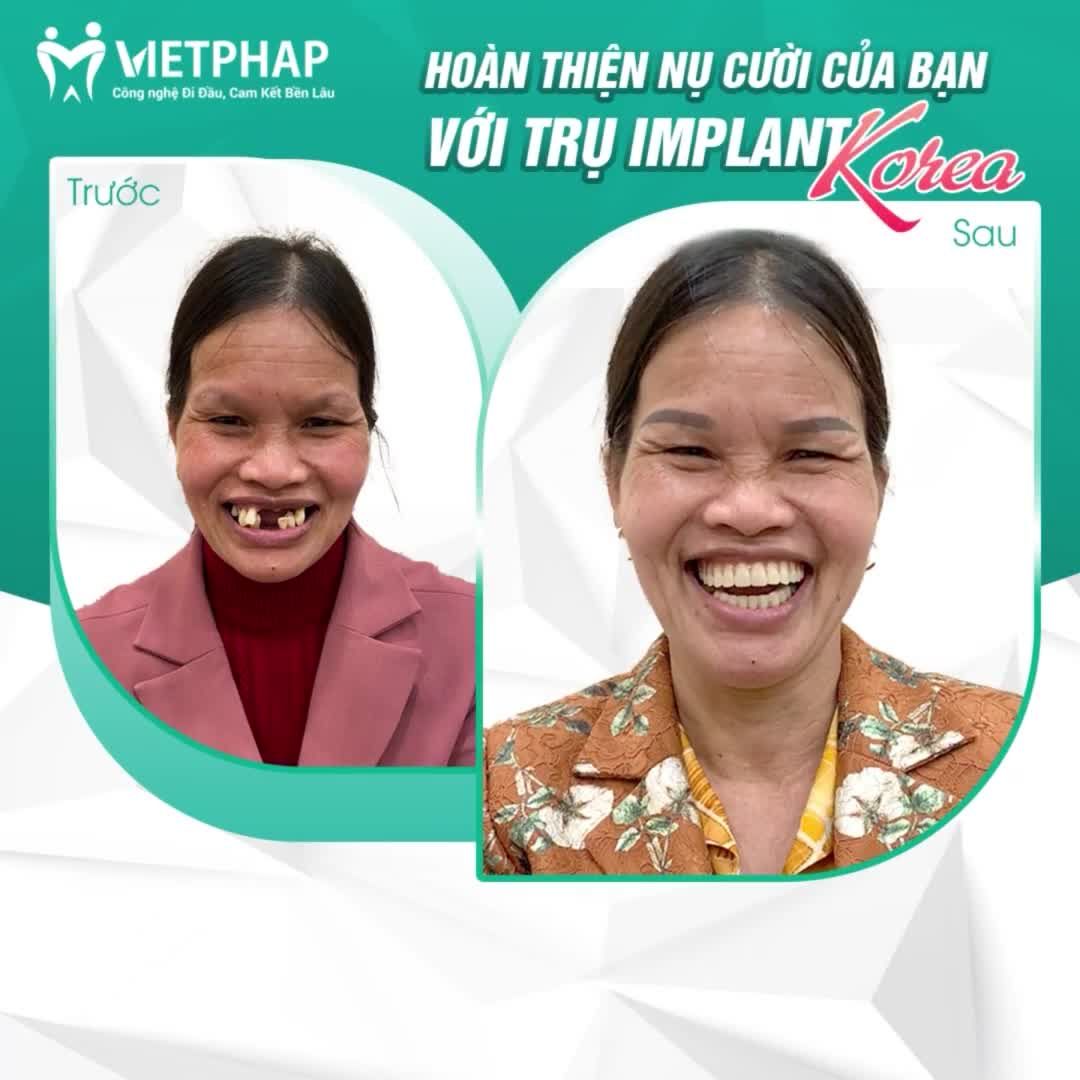 HOÀN THIỆN NỤ CƯỜI CỦA BẠN VỚI DÒNG TRỤ IMPLANT KOREA