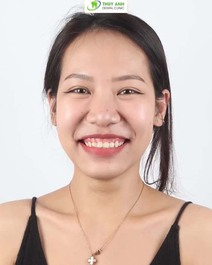 HƠN 2.000 KHÁCH HÀNG CÓ NỤ CƯỜI RẠNG NGỜI SAU CHỮA CƯỜI HỞ LỢI TẠI NK THÙY ANH