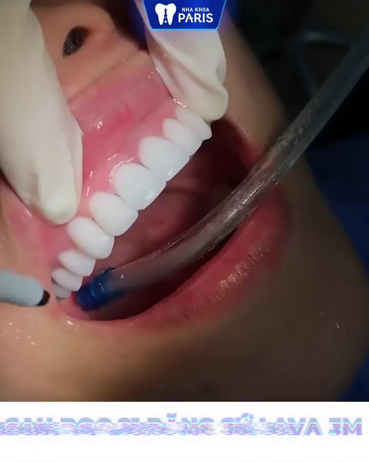 Khoe nhẹ răng sứ của chị An 2 phút trước