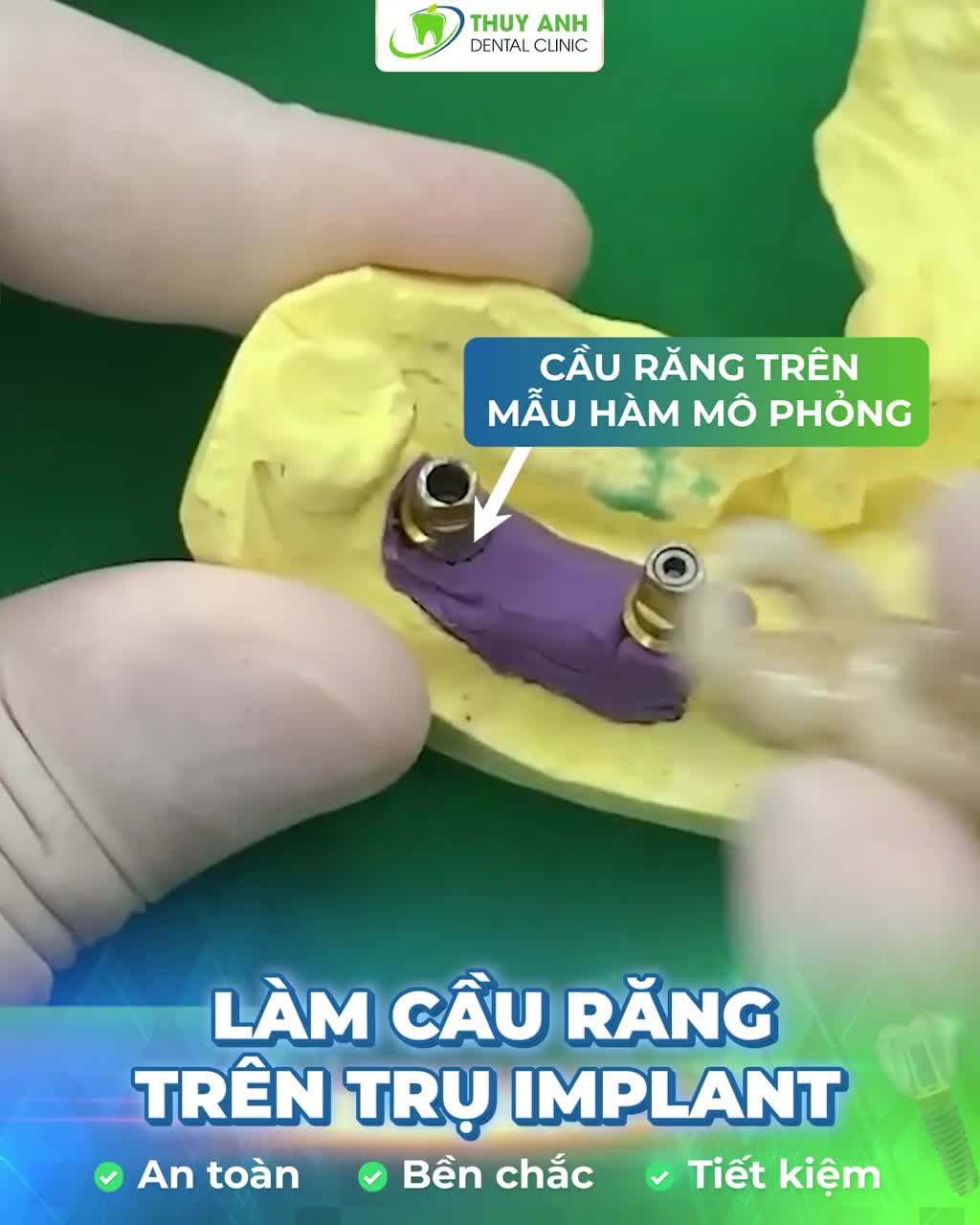 LÀM CẦU RĂNG TRÊN TRỤ IMPLANT PHỤC HÌNH NHIỀU RĂNG MẤT