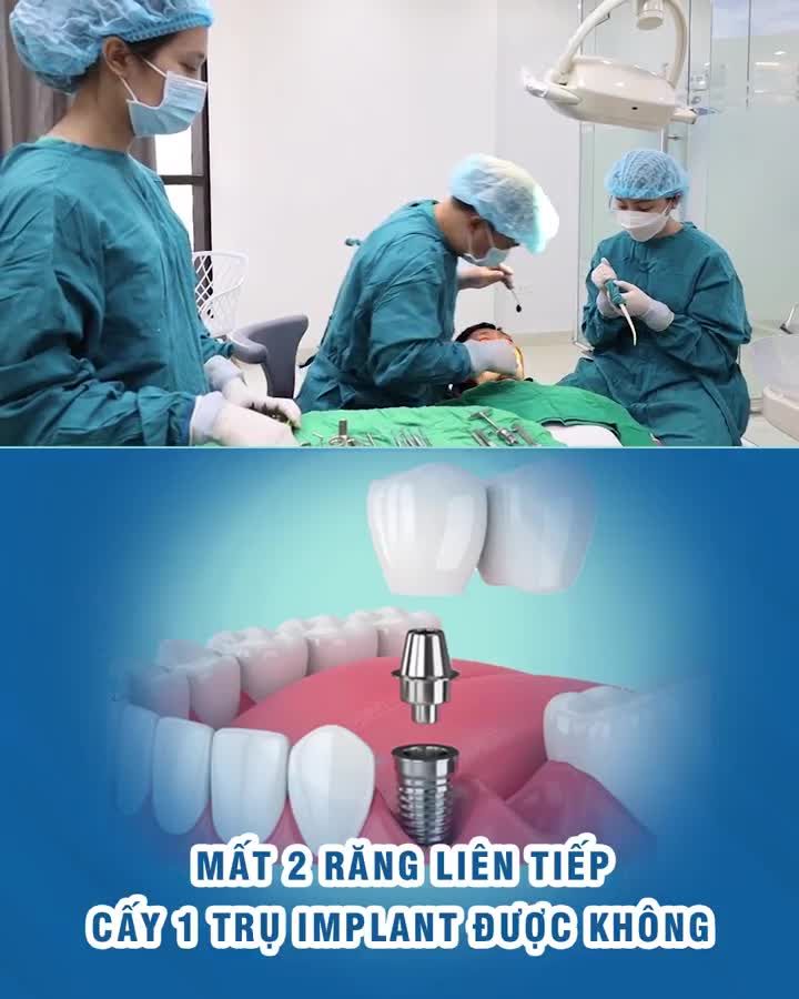 Mất 2 răng liên tiếp cấy 1 trụ Implant được không