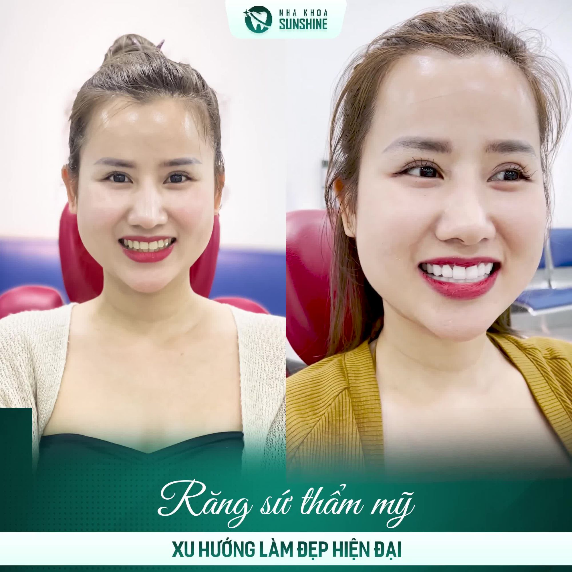 Nếu không làm răng, sao biết mình có ngũ quan xinh như hoa hậu.