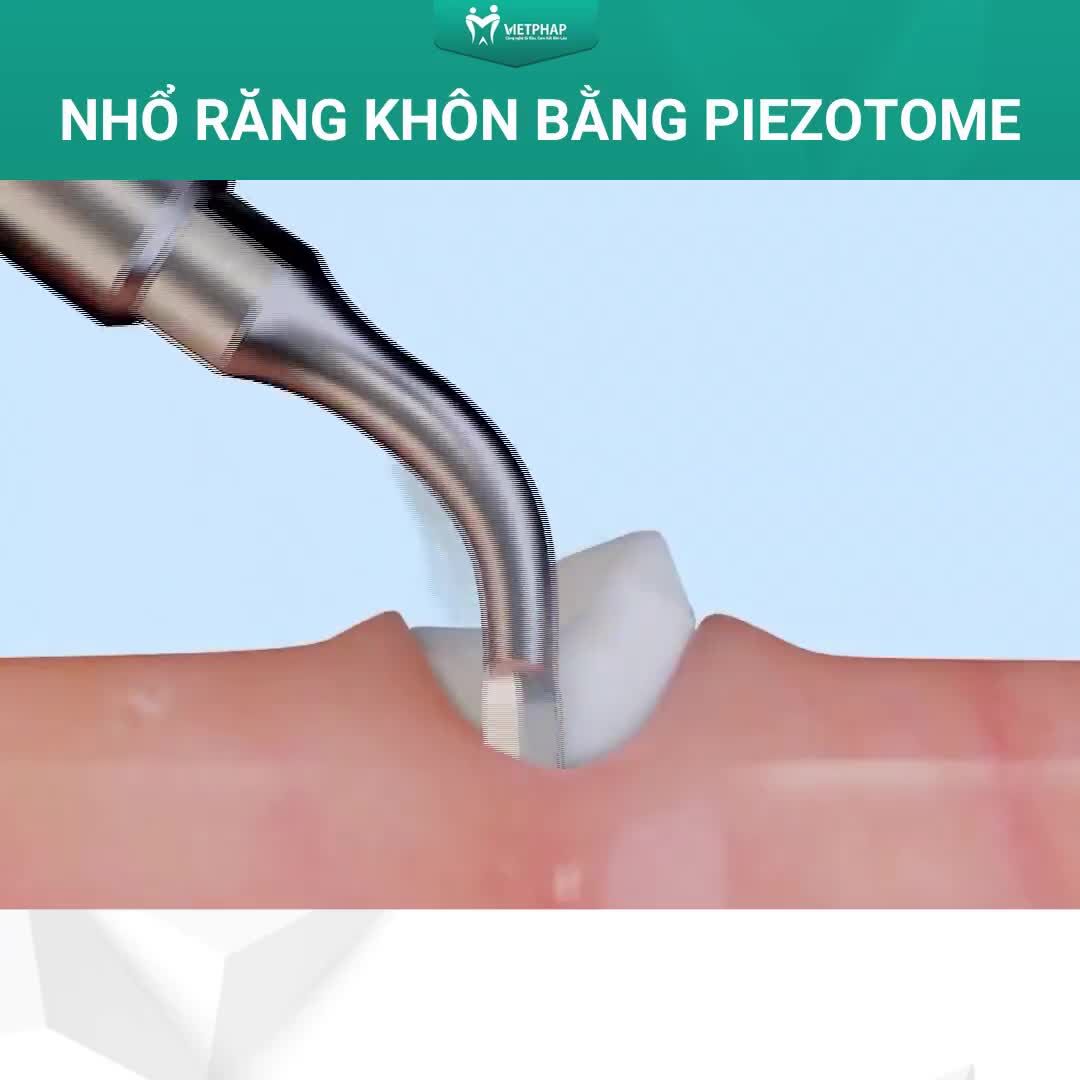 NHỔ RĂNG KHÔN BẰNG CÔNG NGHỆ PIEZOTOME