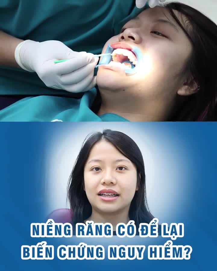 Niềng răng có để lại biến chứng nguy hiểm