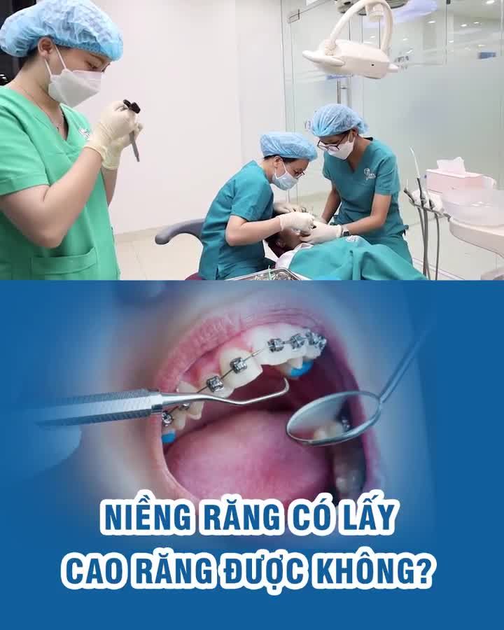 Niềng răng có lấy cao răng được không