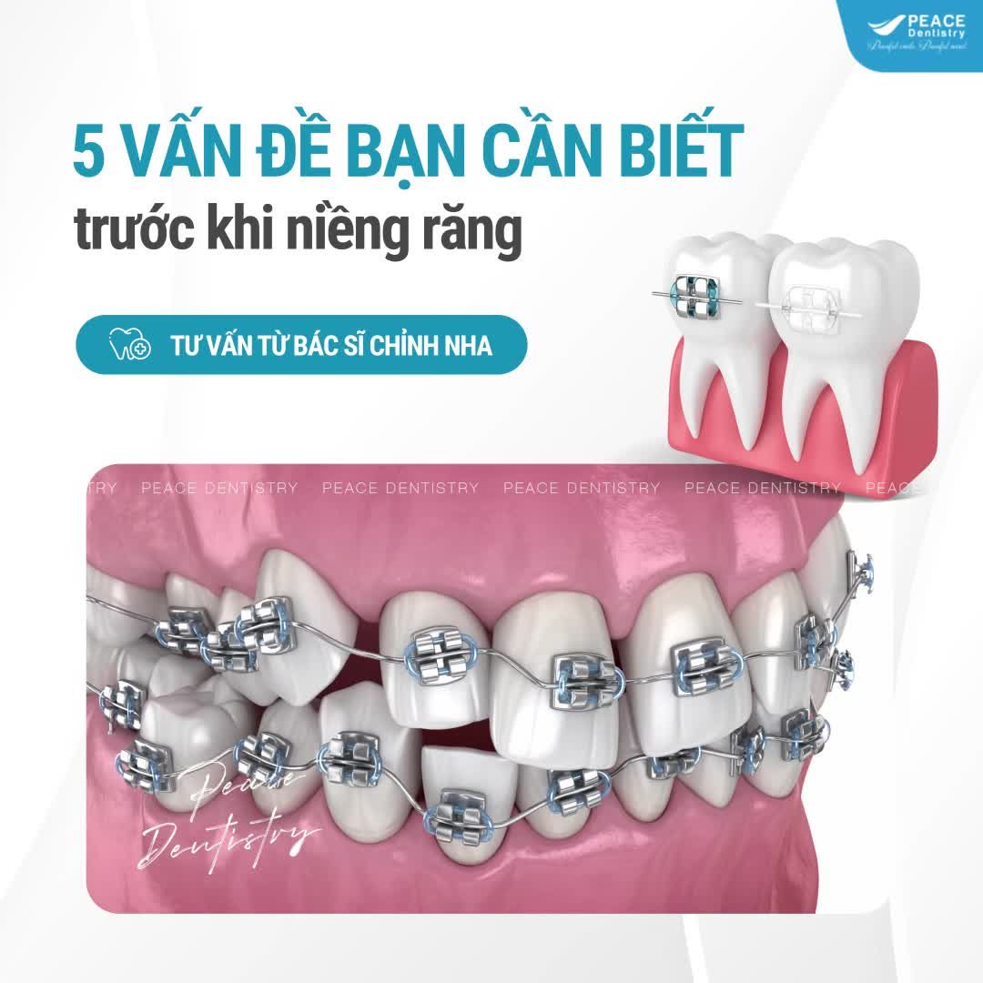 NIỀNG RĂNG LÀ MỘT QUYẾT ĐỊNH QUAN TRỌNG - BẠN CẦN HIỂU ĐÚNG ĐỂ LỰA CHỌN SÁNG SUỐT !