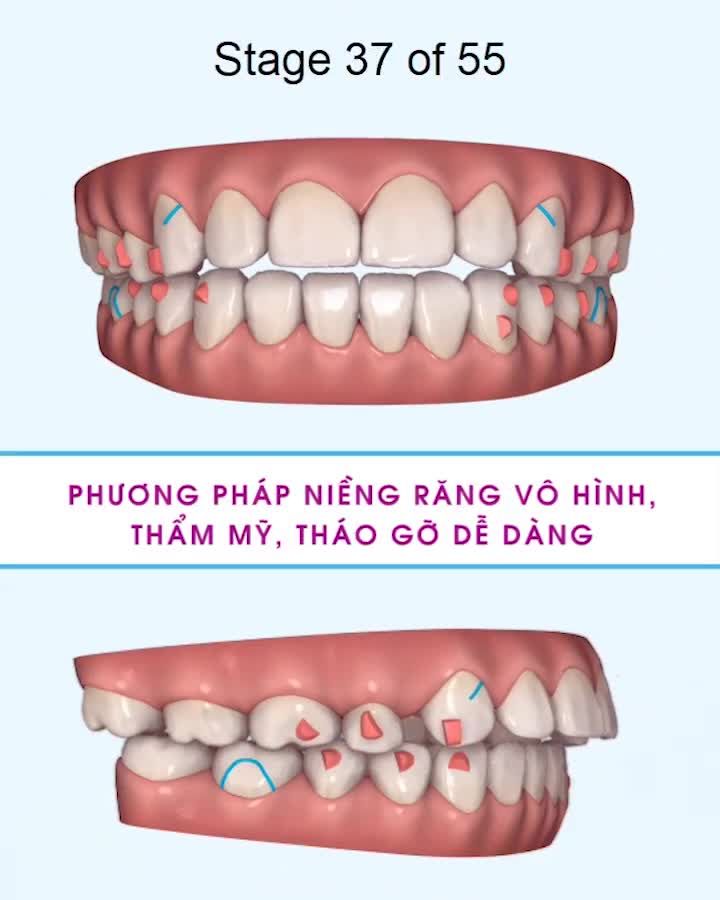 NIỀNG RĂNG TRONG SUỐT