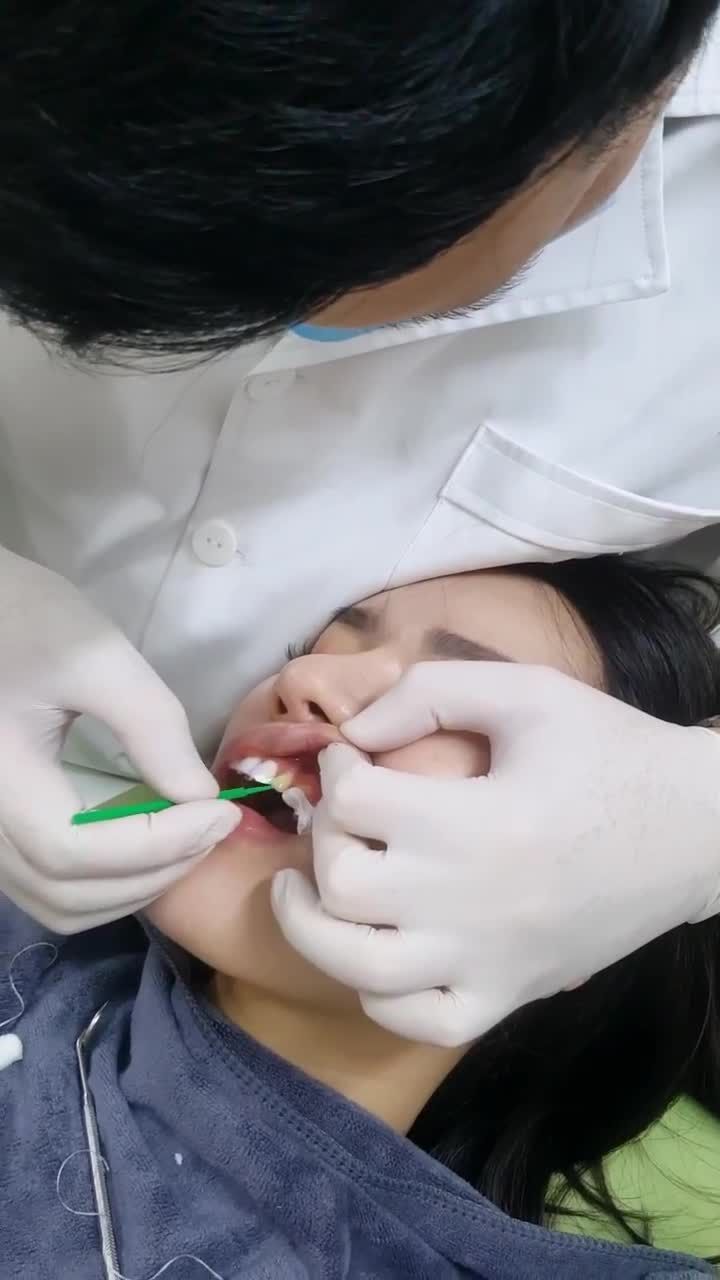 QUÁ TRÌNH DÁN SỨ VENEER CHO KHÁCH HÀNG THÚY HẰNG