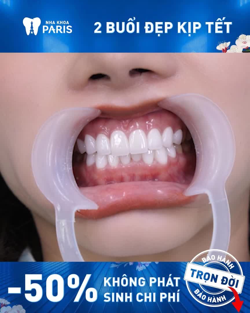 Siêu phẩm Răng Sứ Đẹp Ngây Ngất chuẩn Hotgirl