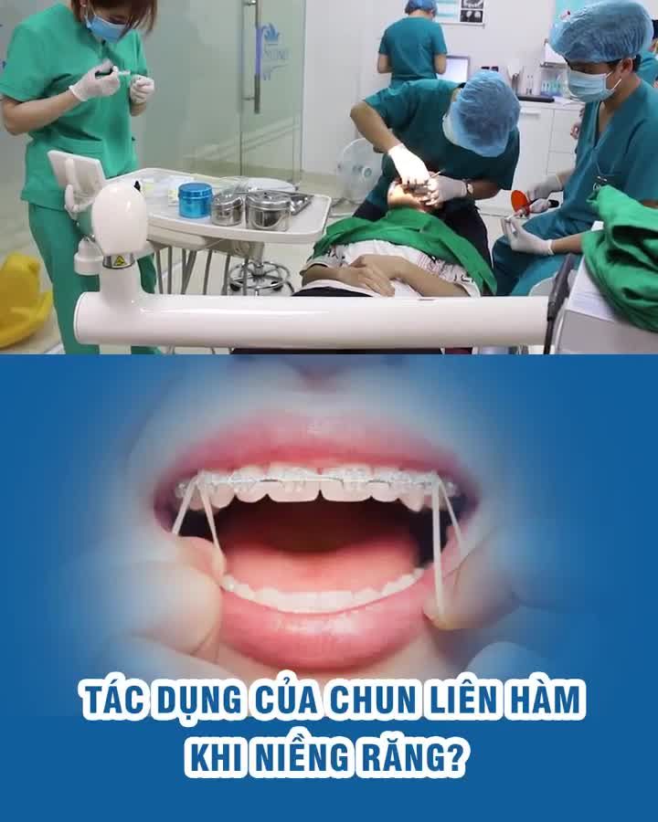 Tác dụng của chun liên hàm khi niềng răng