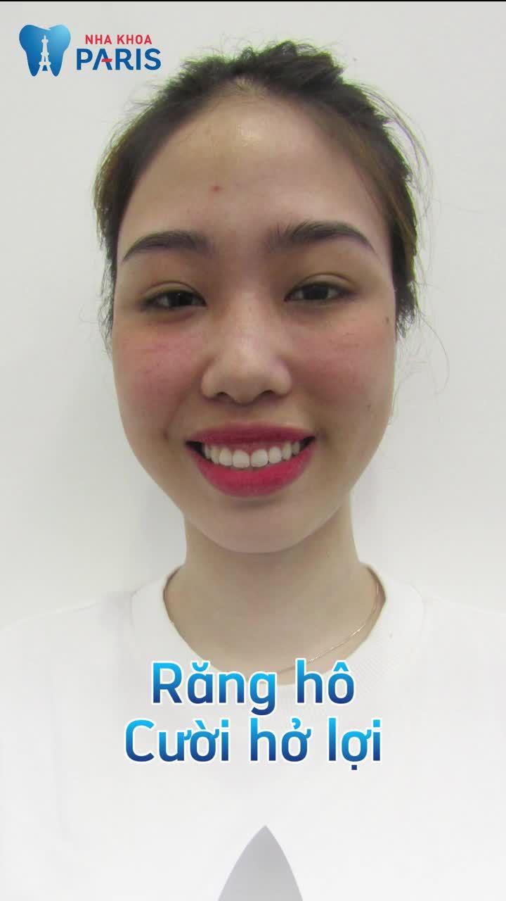 Thời điểm vàng Niềng răng trong suốt