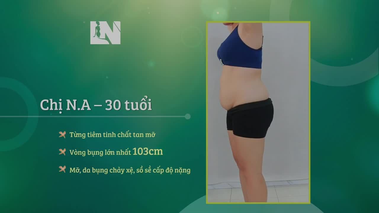 Tình trạng vòng bụng của Chị N.A – 30 tuổi