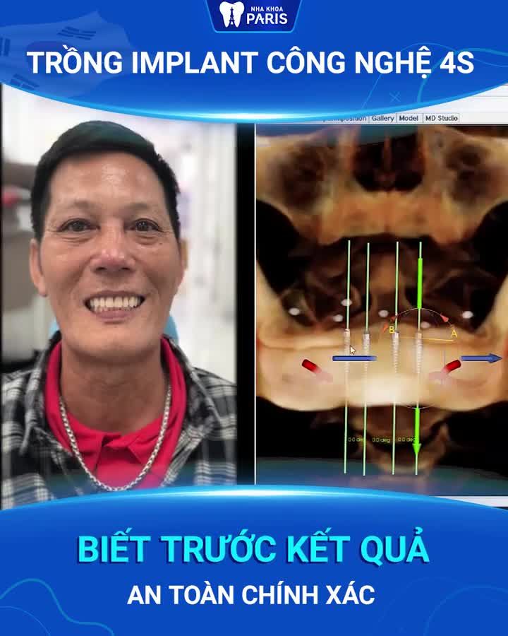Trồng Implant 4S - BIẾT TRƯỚC KẾT QUẢ