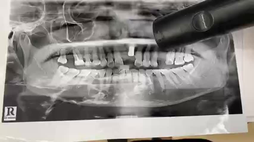 Trồng implant răng số 25 cho cô Liên tại Nha Khoa Thùy Anh.