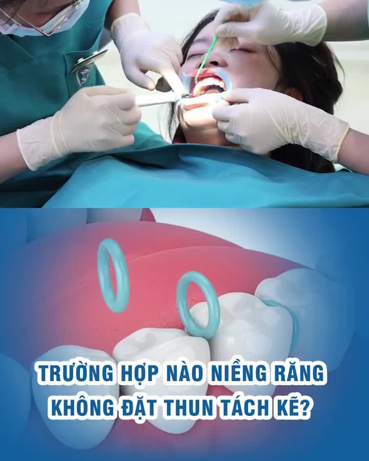 Trường hợp nào niềng răng không đặt thun tách kẽ