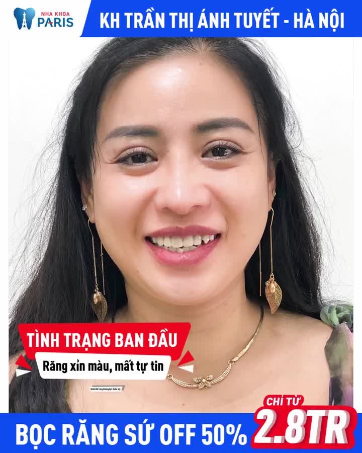 Xóa app trắng răng đi, chị Tuyết làm răng sứ trẻ ra 10 tuổi, tự tin lấy thêm chồng nữa