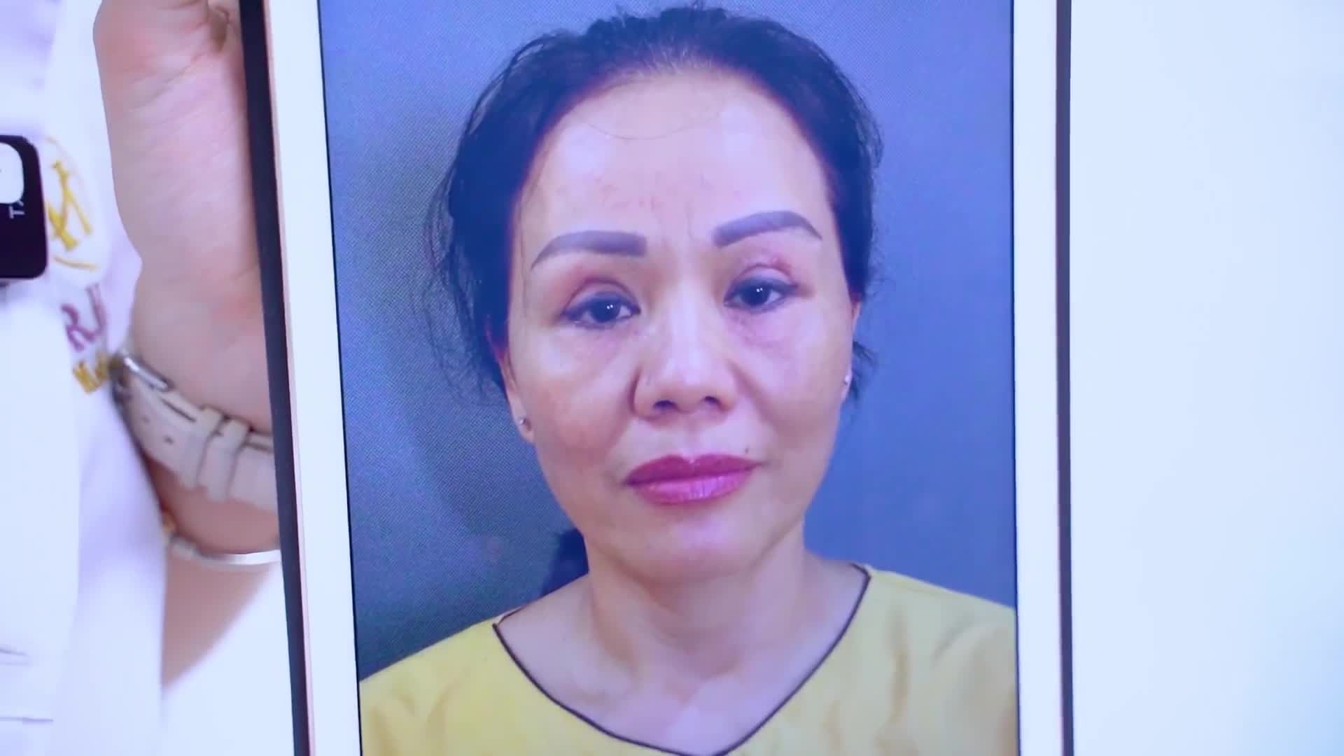 Sửa mí Dr.Hải Lê- sửa là đẹp. Lắng nghe review của khách hàng Việt kiều sau khi sử dụng dịch vụ thẩm mỹ mắt tại Dr.Hải Lê