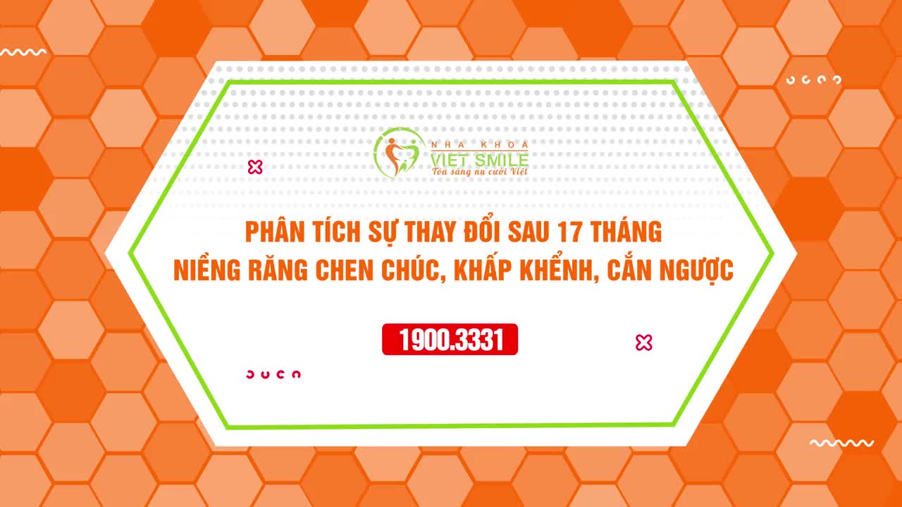 RĂNG KHẤP KHỂNH, MẶT LỆCH THAY ĐỔI RÕ RỆT SAU 17 THÁNG