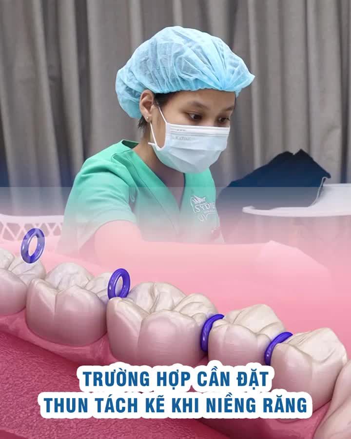 Trường hợp đặt thun tách kẽ khi niềng răng?