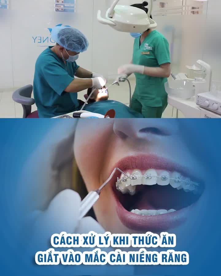 Cách xử lý khi thức ăn giắt vào mắc cài niềng răng