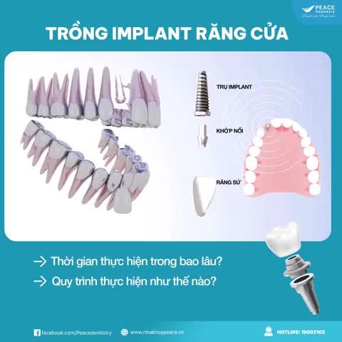 TRỒNG IMPLANT RĂNG CỬA