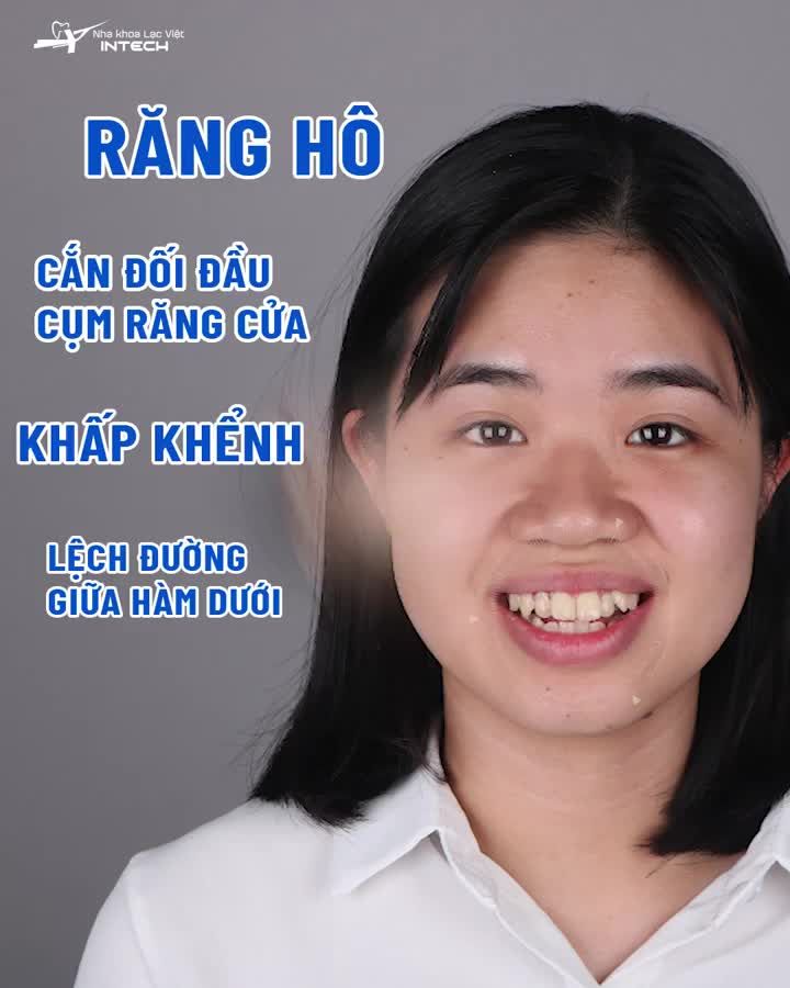 "Điều khiến mình hối hận nhất chính là không niềng răng sớm hơn ..."