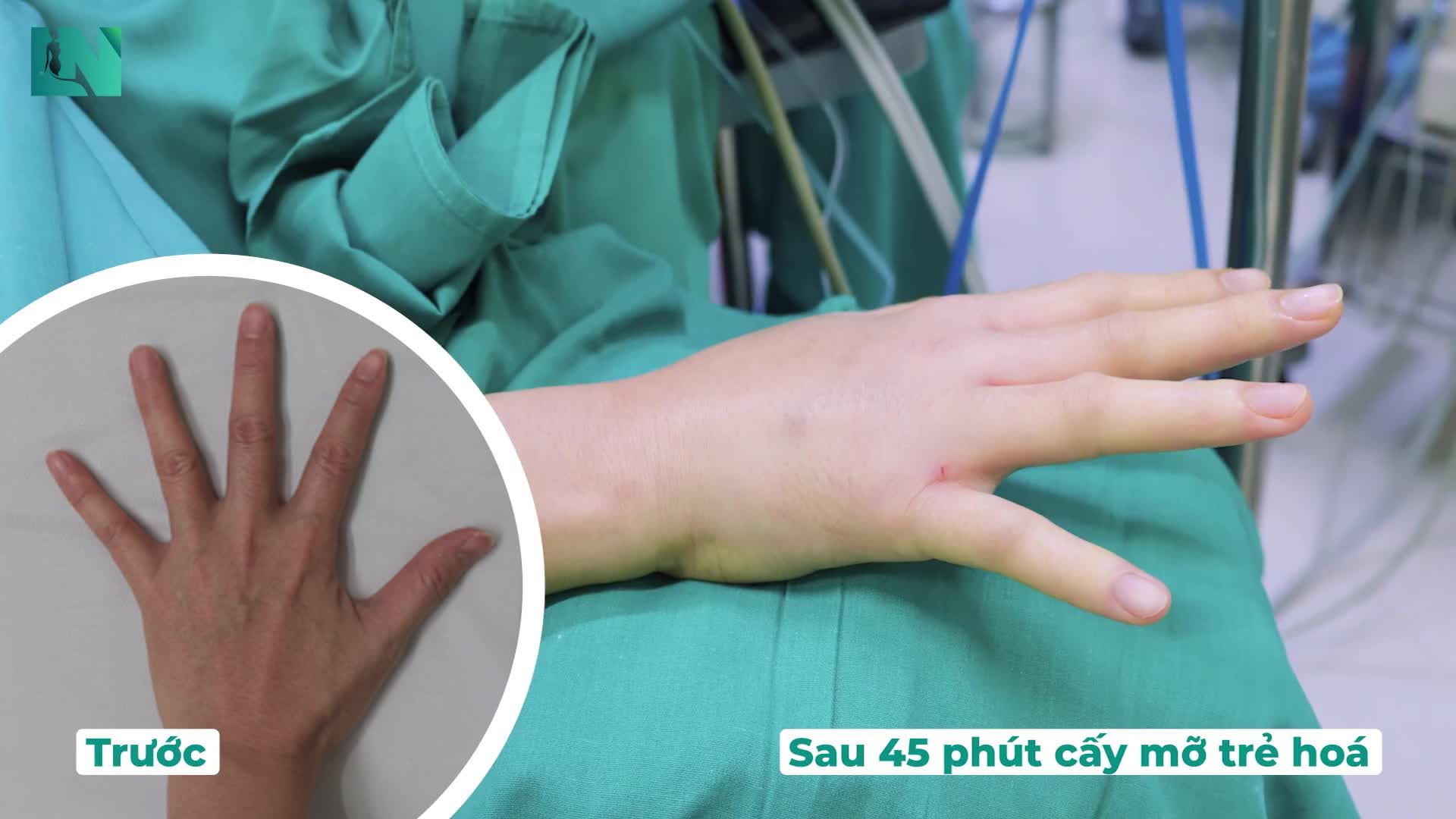 Sau 45 phút cấy mỡ trẻ hoá bàn tay: không còn thây tình trạng gầy guộc, nhăn nheo, thiếu sức sống của bàn tay ở 38 tuổi.