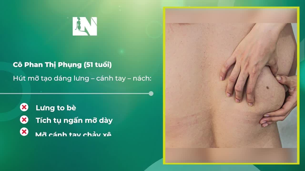 Hành trình  hút mỡ tạo dáng thẩm mỹ của Cô Phụng (51 tuổi) được Ekip ghi lại một cách chi tiết