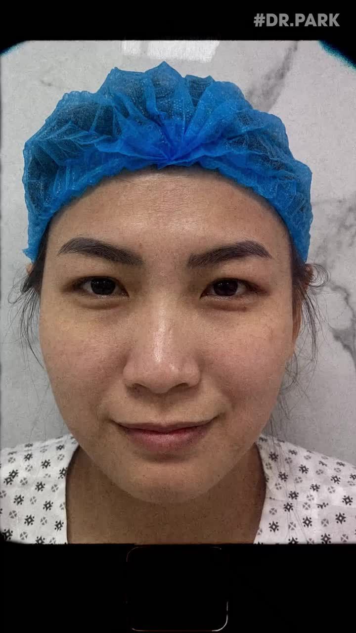 CẮT MÍ EYELID - TỰ TIN THU HÚT MỌI ÁNH NHÌN