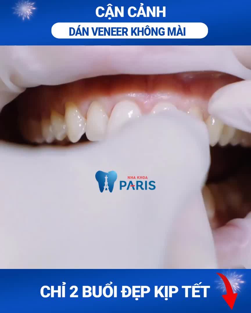 CẬN CẢNH QUY TRÌNH DÁN 20 SỨ VENEER KHÔNG MÀI TẠI NHA KHOA PARIS